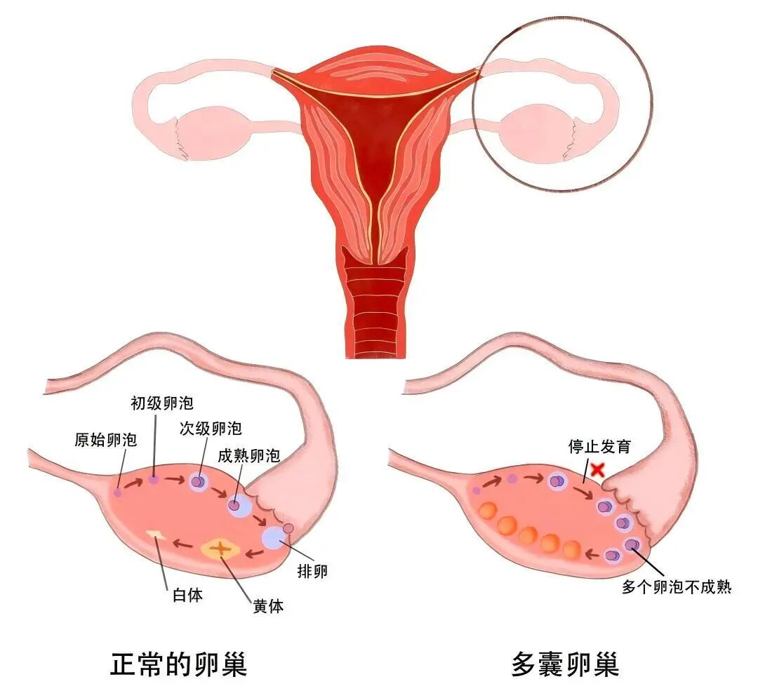 多囊卵巢=不孕？一文看懂多囊患者备孕全攻略